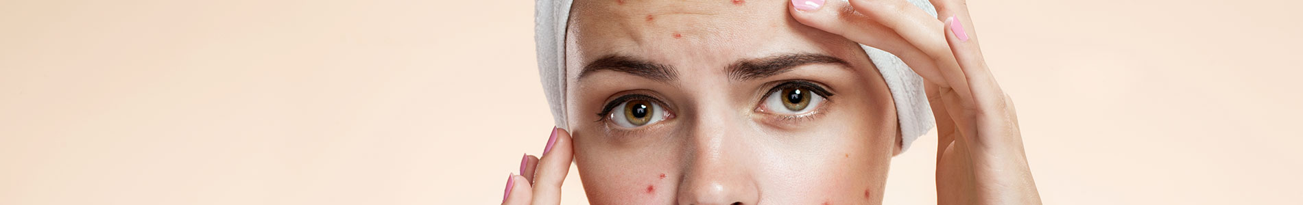 Acne behandeling in Eelde en Paterswolde