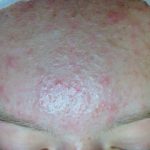 acne therapie in Eelde-Paterwolde, Groningen en Haren . Vergoeding alle zorgverzekeraars