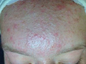 acne therapie in Eelde-Paterwolde, Groningen en Haren . Vergoeding alle zorgverzekeraars