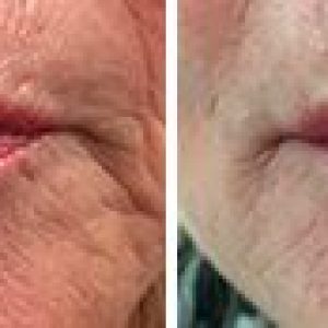 Hangende mondhoeken behandelen met botox en fillers in Eelde Paterswolde Haren Roden Groningen Zuidlaren Roden Peize Zuidlaren