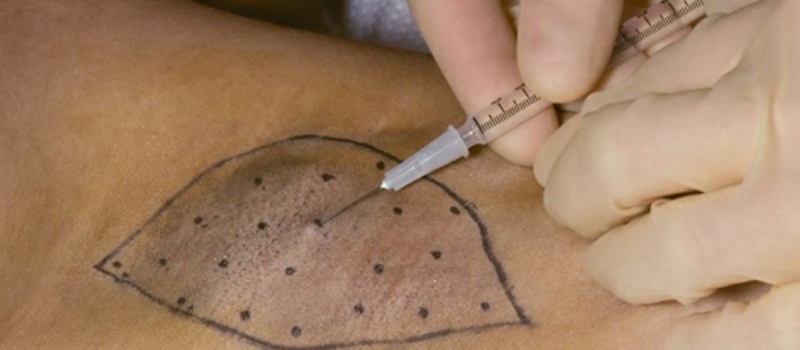 hyperhidrosis overmatig zweten, transpiratie hyperhydrose