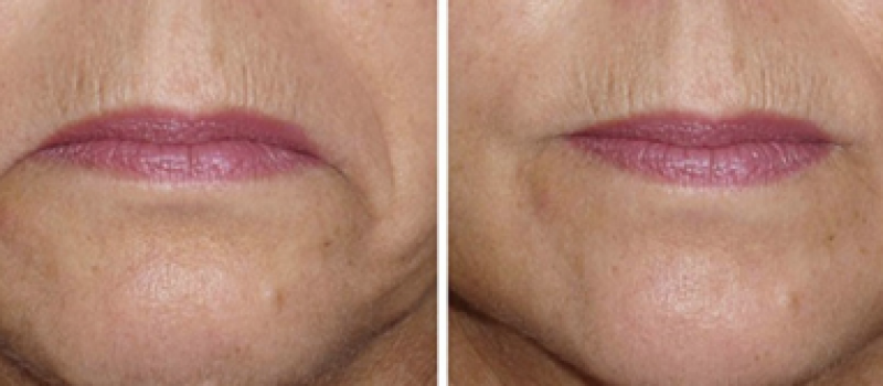 Hangende mondhoeken Hangende mondhoeken behandelen met botox of fillers in Groningen Eelde Paterswolde Haren Tynaarlo Zuidlaren Peize Roden Leek Assen